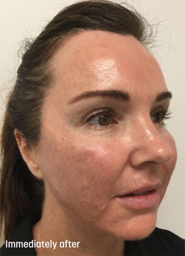 1. TCA Peel Treatment Progress - Immediately After