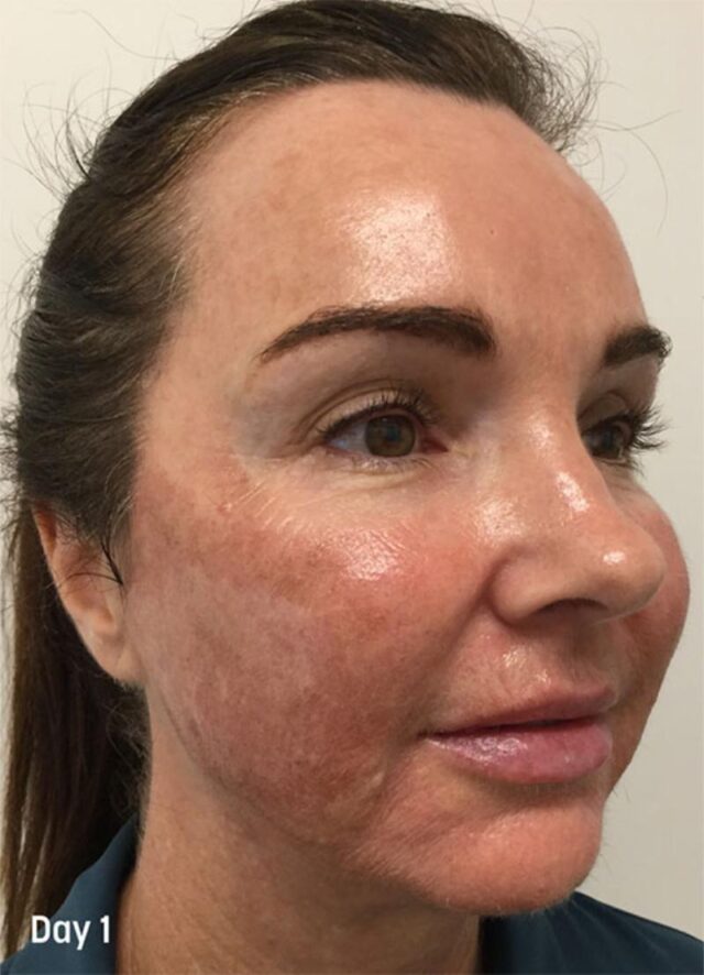 2. TCA Peel Treatment Progress - Day 1