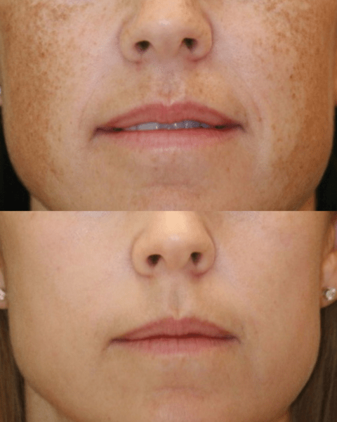 20 Percent Off Peels Before And After Peel Image