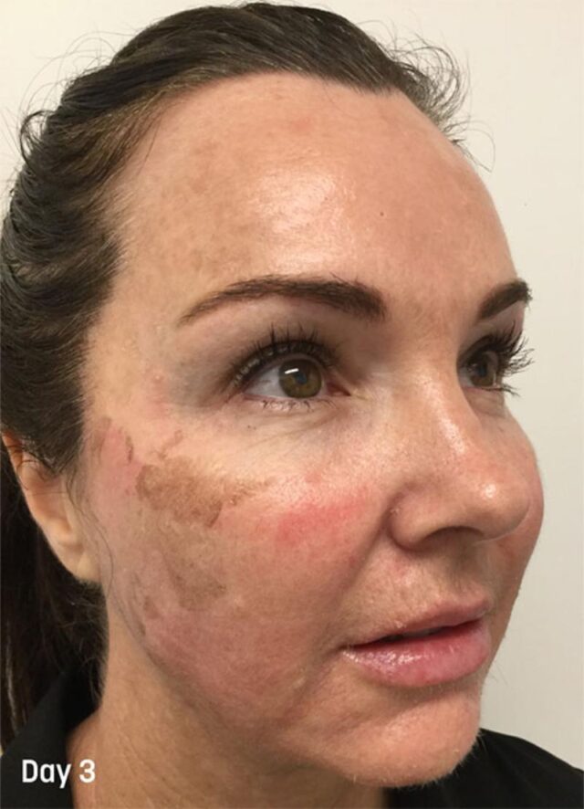 3. TCA Peel Treatment Progress - Day 3