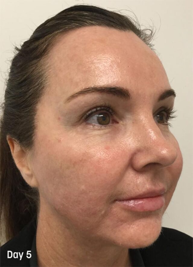 4. TCA Peel Treatment Progress - Day 4