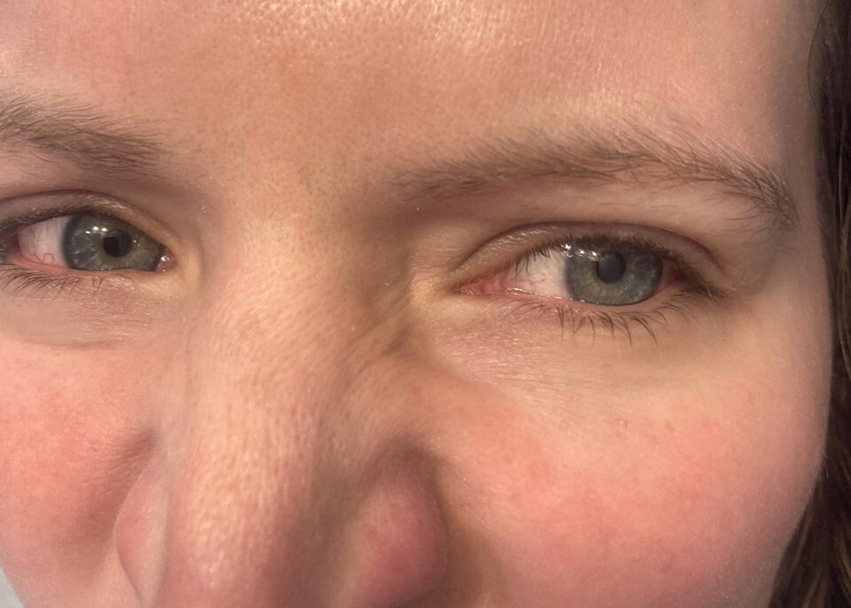 Bunny Lines What causes bunny lines and how personalised care can help manage them.