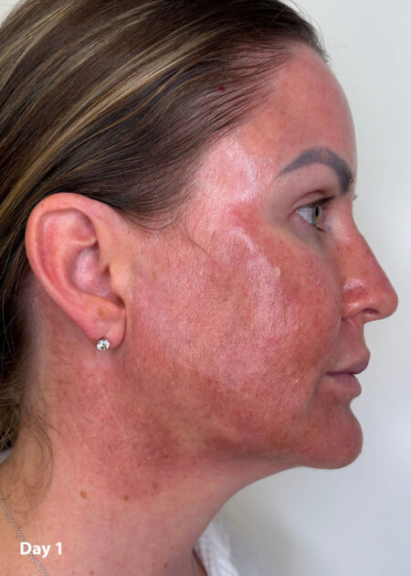 Cosmo Peel Forte Progress - Day 1