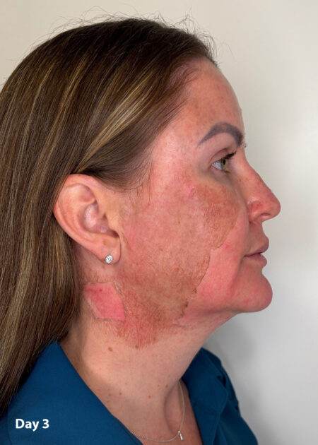 Cosmo Peel Forte Progress - Day 3