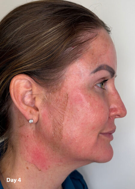 Cosmo Peel Forte Progress - Day 4