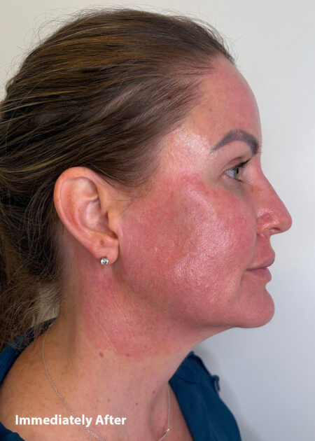 Cosmo Peel Forte Progress - Immediately after