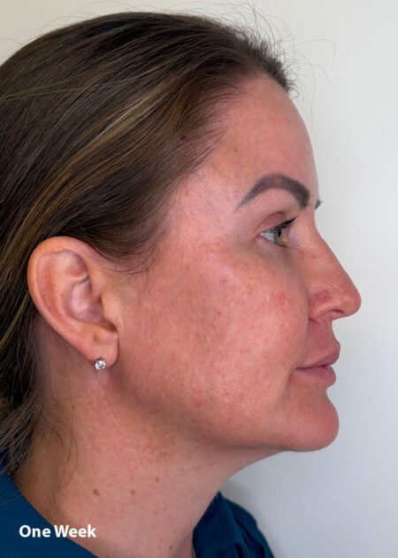 Cosmo Peel Forte Progress - One week