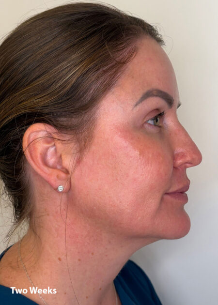 Cosmo Peel Forte Progress - Two weeks
