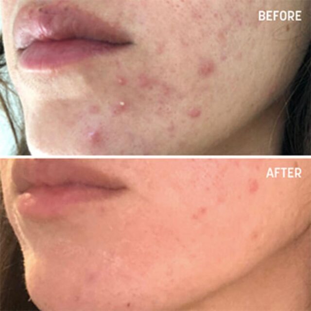 Dermapen Skin Needling