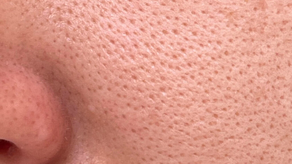 What Is the Best Treatment for Enlarged Pores? Proven Methods for Reducing Enlarged Pore Visibility