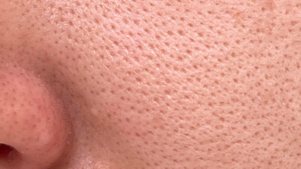 What Is the Best Treatment for Enlarged Pores? Proven Methods for Reducing Enlarged Pore Visibility