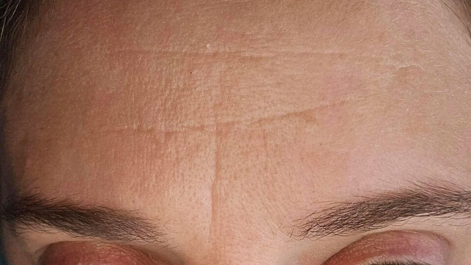 Forehead Lines Advanced Treatments for Forehead Wrinkle Correction
