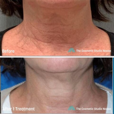 Genius RF Microneedling Treatments