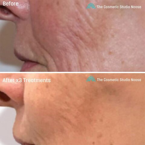 Genius RF Microneedling Treatments