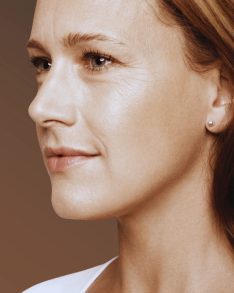 How to Treat Crow's Feet - A Complete Guide to Prevention and Treatment