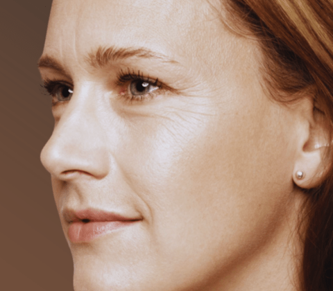 How to Treat Crow's Feet - A Complete Guide to Prevention and Treatment
