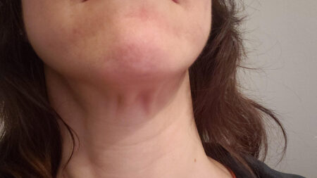 How to Treat Sagging Neck Skin Without Surgery