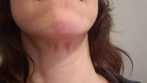 How to Treat Sagging Neck Skin Without Surgery