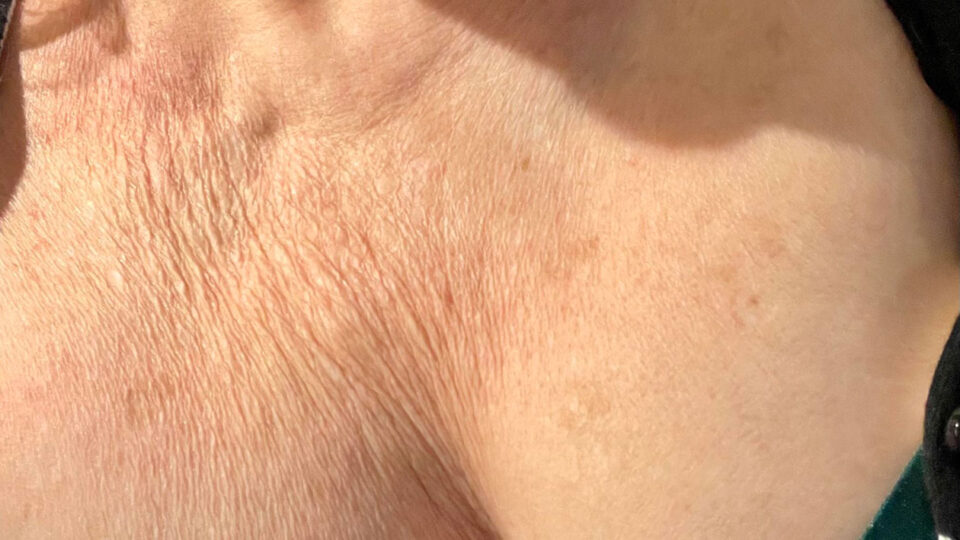 How to Treat Sun Damaged Skin Treatments that target pigmentation and ageing.