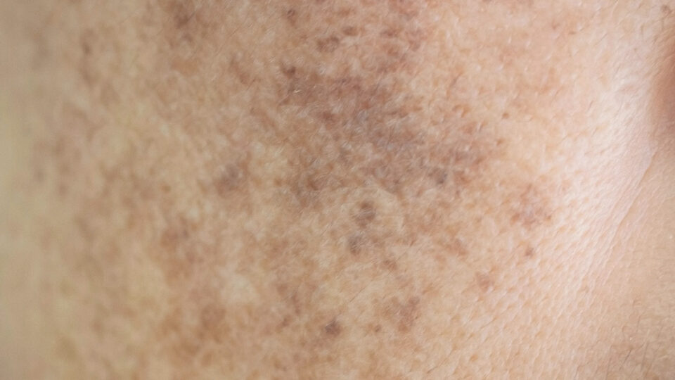 Hyperpigmentation
