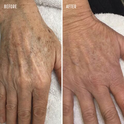 Laser Treatment for Pigmentation - Before and After