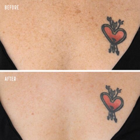 Laser Treatment for Pigmentation - Before and After