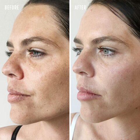 Laser Treatment for Pigmentation - Before and After