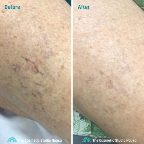 Leg Spider Veins Telangiectasias Treatment - Before and After