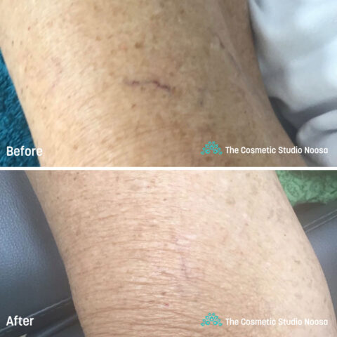 Leg Spider Veins Telangiectasias Treatment - Before and After