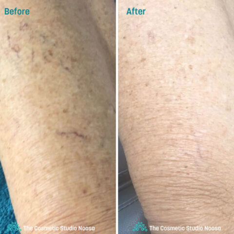 Leg Spider Veins Telangiectasias Treatment - Before and After
