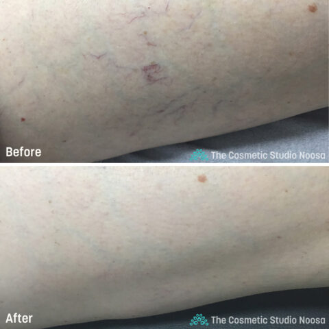 Leg Spider Veins Telangiectasias Treatment - Before and After