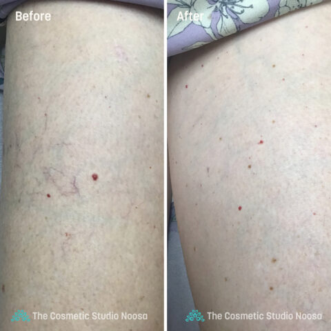 Leg Spider Veins Telangiectasias Treatment - Before and After