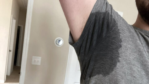 Man's Armpit with Hyperhidrosis