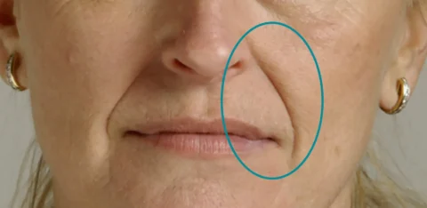 Nasolabial (Smile) Folds - When To Support Cheeks vs Treat the Fold