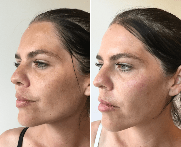 Get Your Winter Skin-On With Brookes Laser IPL Therapies Professional Light Treatments for Clearer, Smoother Skin