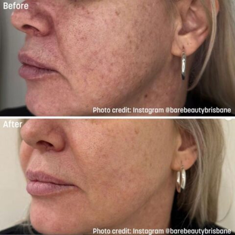 Rejuran Treatments