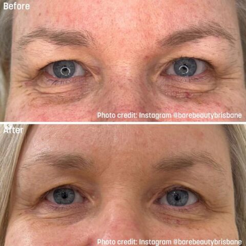 Rejuran Treatments - Before and After
