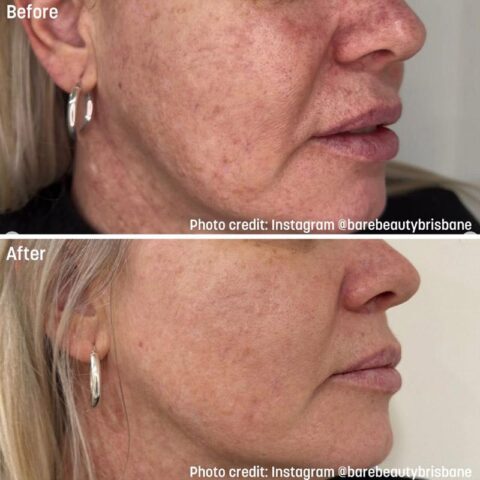 Rejuran Treatments - Before and After