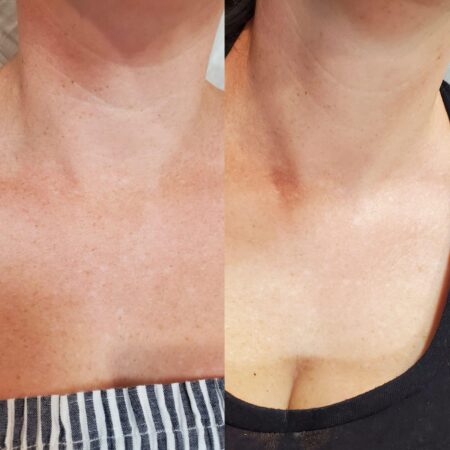 SQT Bio-Microneedling Noosa - Before and After 1