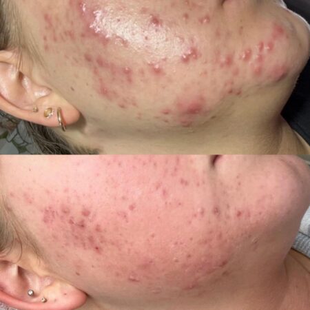 SQT Bio-Microneedling Noosa - Before and After 2