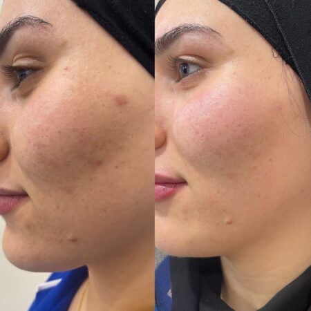 SQT Bio-Microneedling Noosa - Before and After 3