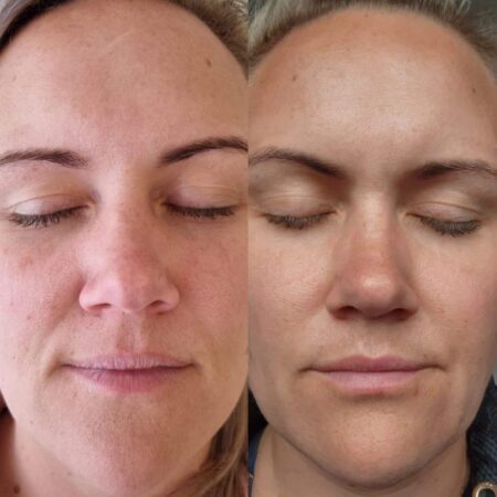 SQT Bio-Microneedling Noosa - Before and After 4