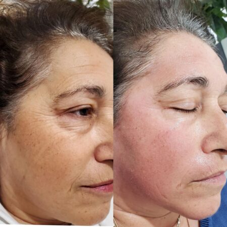 SQT Bio-Microneedling Noosa - Before and After 5
