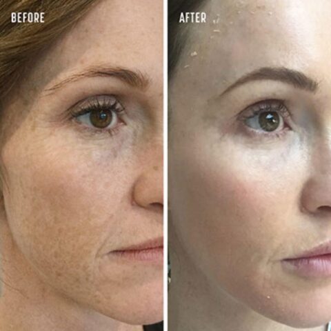 TCA Peel Treatments