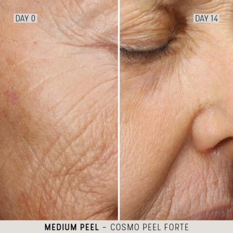 The Cosmetic Studio - Cosmo Peel Forte Before and After 01