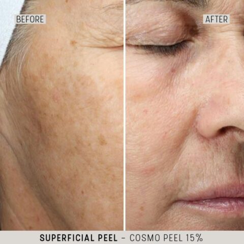 The Cosmetic Studio - Cosmo Peel Forte Before and After 01