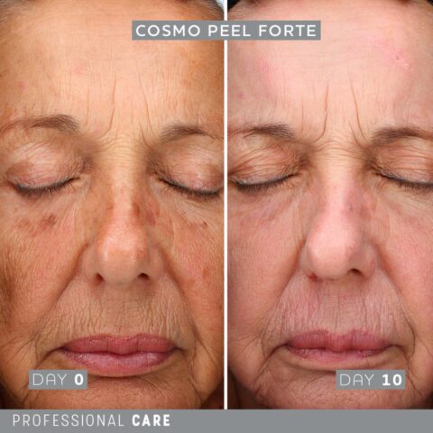 The Cosmetic Studio - Cosmo Peel Forte Before and After 01