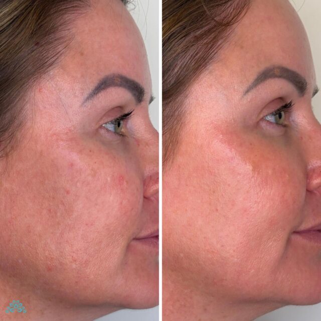 Cosmo Peel Forte in Noosaville on the Sunshine Coast: Advanced peel for sun‑damaged, pigmented and textured skin