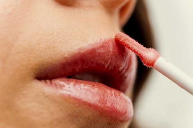 Upper Lip Enhancement Treatments in Noosaville on the Sunshine Coast: Subtle Enhancement for a Natural-Looking Smile.