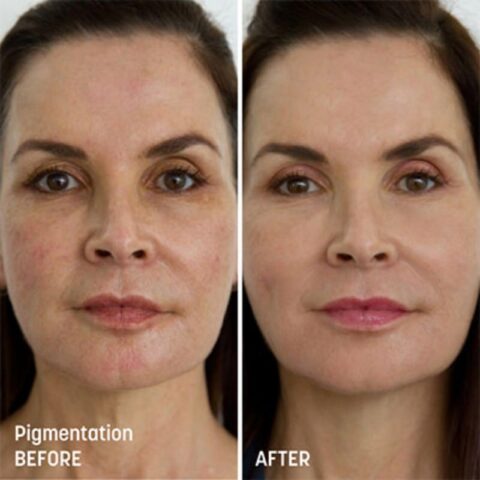 VI Peel Treatments - Before and After